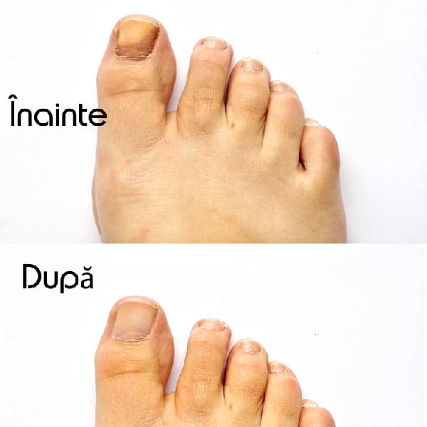 dezinfectie cu ciuperca unghiilor de la picioare